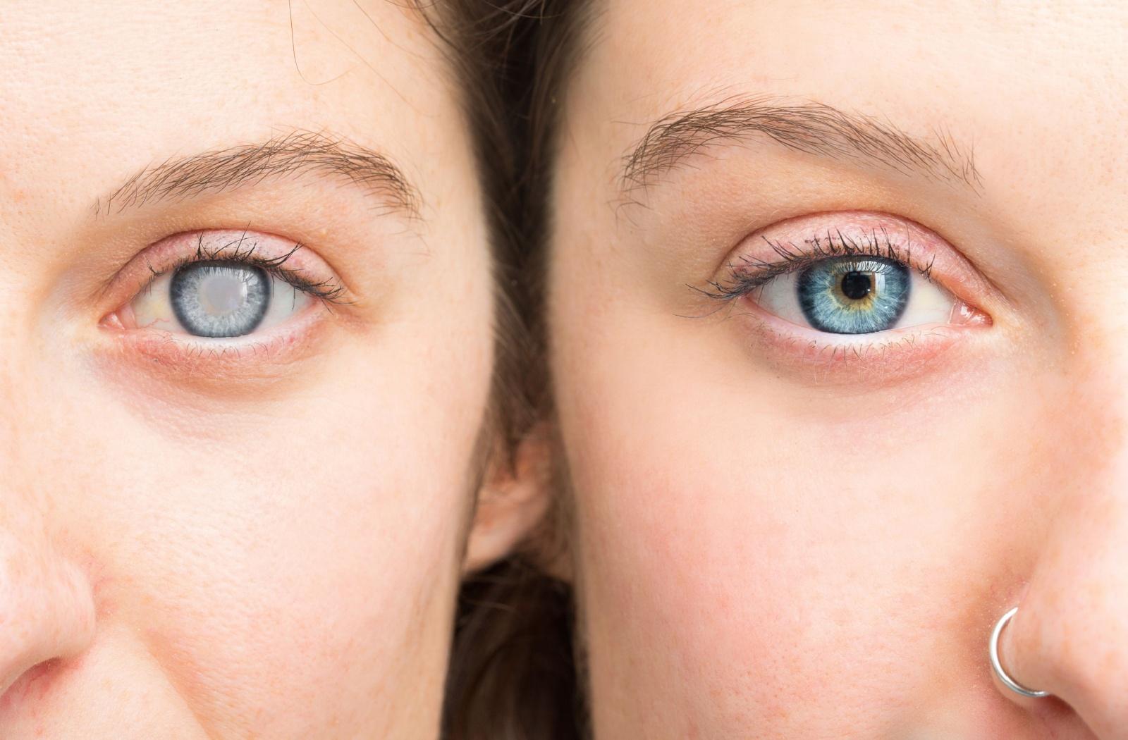 A close-up of two people's eyes, one with glaucoma clouding and one without.