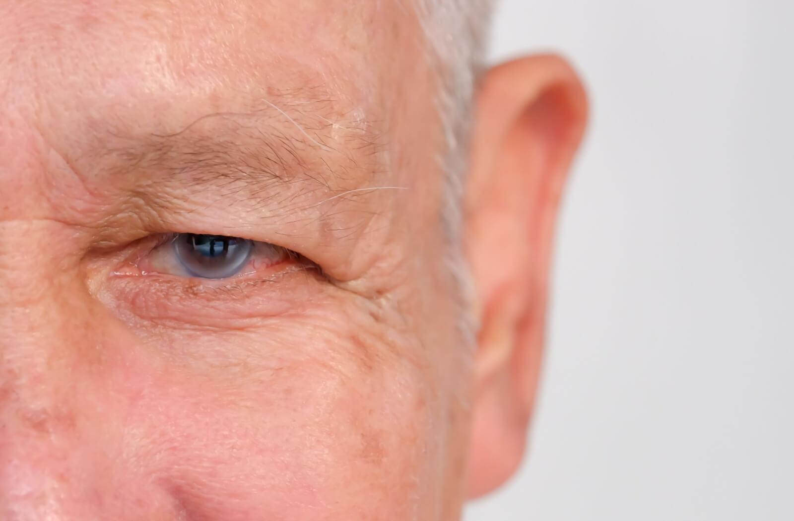 A person's eyes show signs of clouding, likely from a cataract.