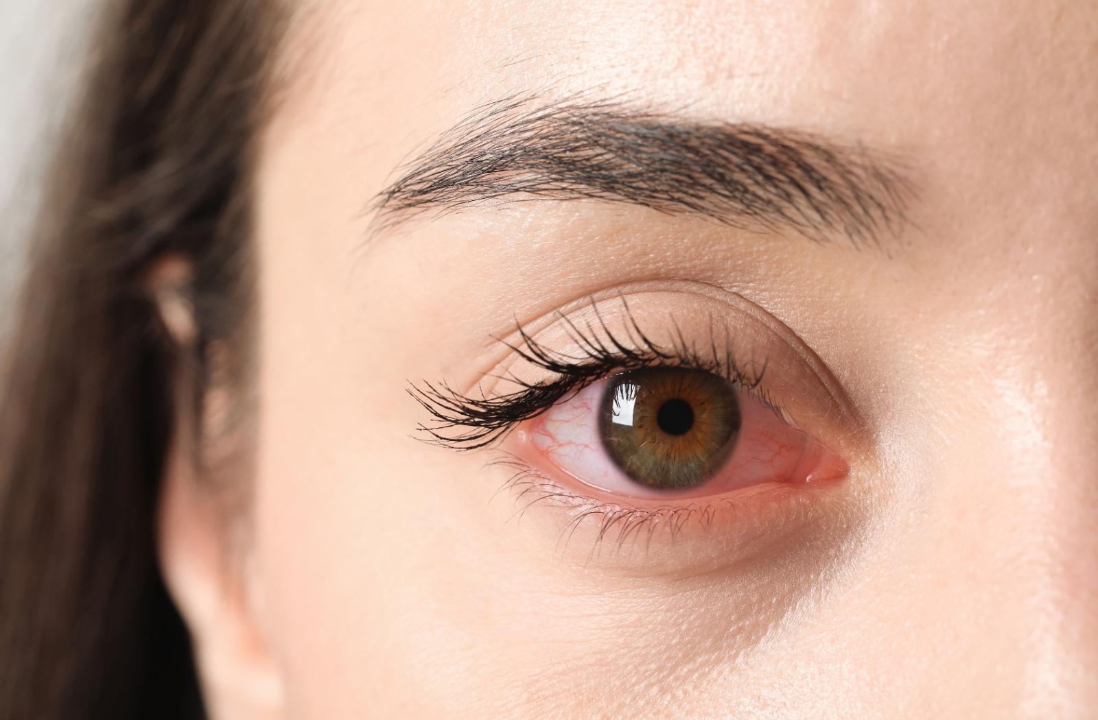Close-up of a woman's red and irritated eye, showing visible redness in the sclera.